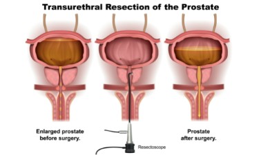 Transurethral Resection of the Prostate