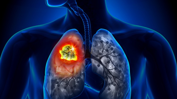 Lung Cancer In Men