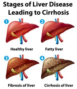 Alcohol-Related Liver Disease